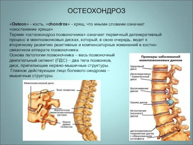 ОСТЕОХОНДРОЗ «Osteon» - кость, «chondros» - хрящ, что иными словами означает