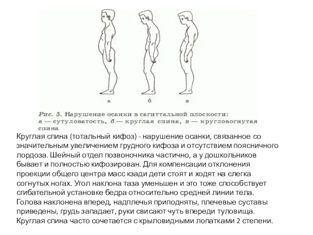 Круглая спина (тотальный кифоз) - нарушение осанки, связанное со значительным увеличением