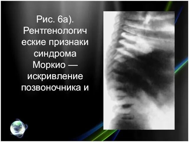 Рис. 6а). Рентгенологические признаки синдрома Моркио — искривление позвоночника и платиспондилия.