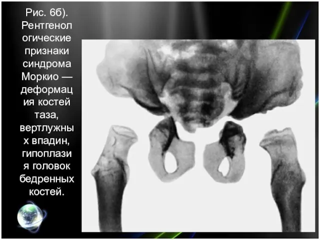 Рис. 6б). Рентгенологические признаки синдрома Моркио — деформация костей таза, вертлужных впадин, гипоплазия головок бедренных костей.