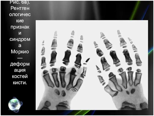 Рис. 6в). Рентгенологические признаки синдрома Моркио — деформация костей кисти.