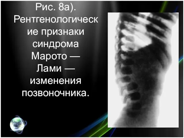 Рис. 8а). Рентгенологические признаки синдрома Марото — Лами — изменения позвоночника.