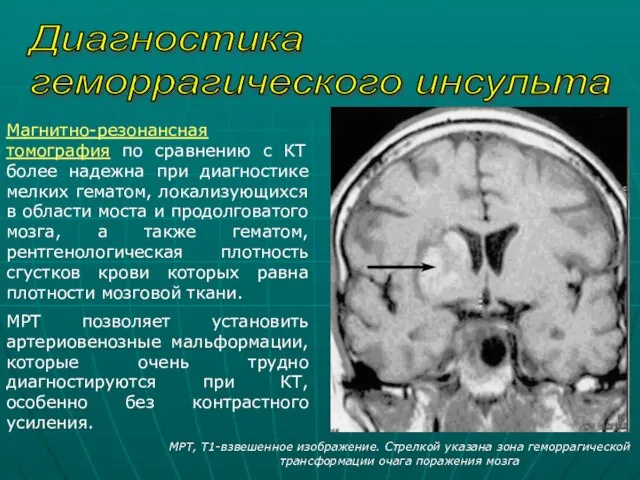 Диагностика геморрагического инсульта Магнитно-резонансная томография по сравнению с КТ более надежна