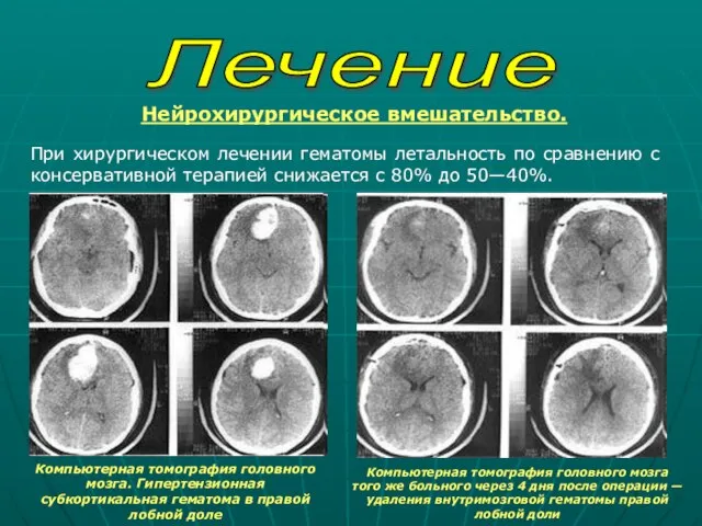 Лечение Нейрохирургическое вмешательство. При хирургическом лечении гематомы летальность по сравнению с