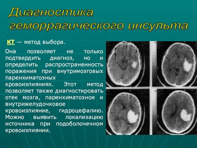 Диагностика геморрагического инсульта КТ — метод выбора. Она позволяет не только