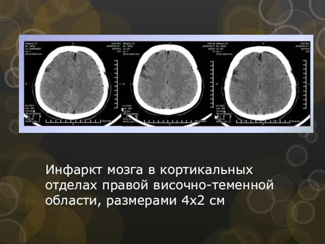 Инфаркт мозга в кортикальных отделах правой височно-теменной области, размерами 4х2 см