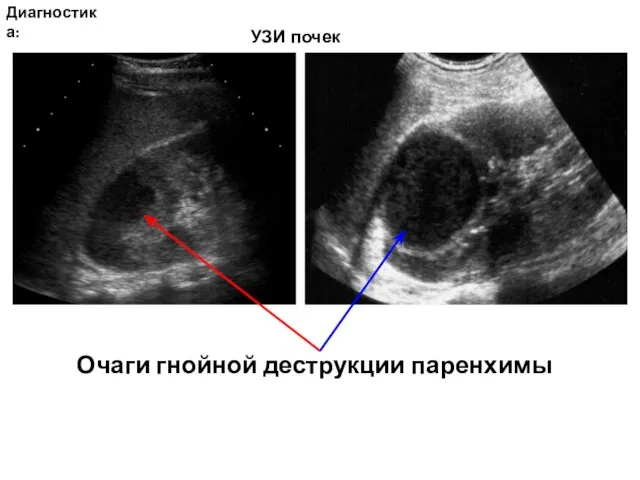 Диагностика: Очаги гнойной деструкции паренхимы УЗИ почек