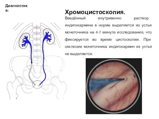 Диагностика: Хромоцистоскопия. Введённый внутривенно раствор индигокармина в норме выделяется из устья