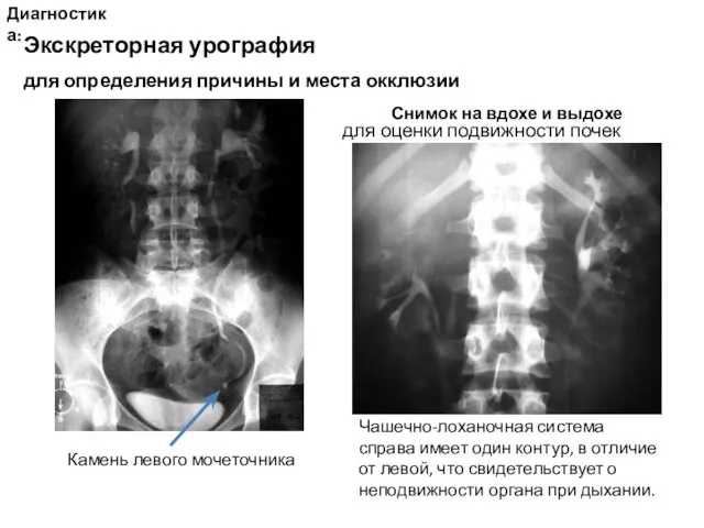 Диагностика: Экскреторная урография для определения причины и места окклюзии Снимок на