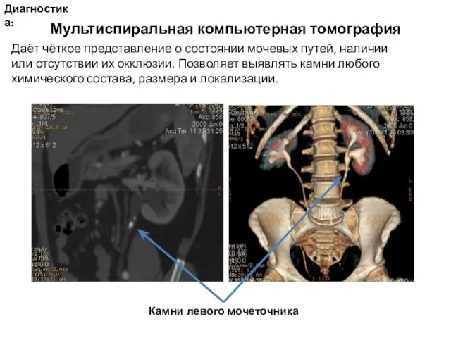 Диагностика: Мультиспиральная компьютерная томография Даёт чёткое представление о состоянии мочевых путей,
