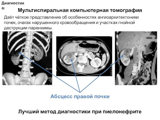 Диагностика: Лучший метод диагностики при пиелонефрите Мультиспиральная компьютерная томография Даёт чёткое