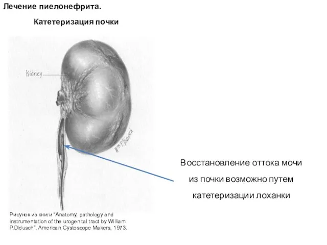 Катетеризация почки Лечение пиелонефрита. Восстановление оттока мочи из почки возможно путем