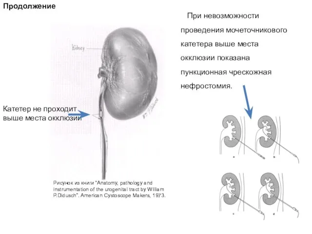 Продолжение Катетер не проходит выше места окклюзии При невозможности проведения мочеточникового