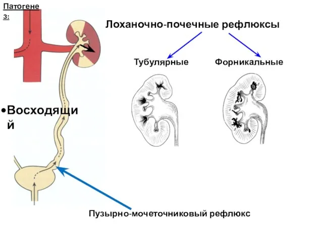 Патогенез: Лоханочно-почечные рефлюксы Тубулярные Форникальные Восходящий Пузырно-мочеточниковый рефлюкс