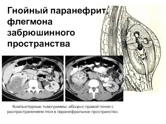 Гнойный паранефрит, флегмона забрюшинного пространства Компьютерные томограммы: абсцесс правой почки с распрастранением гноя в паранефральное пространство.