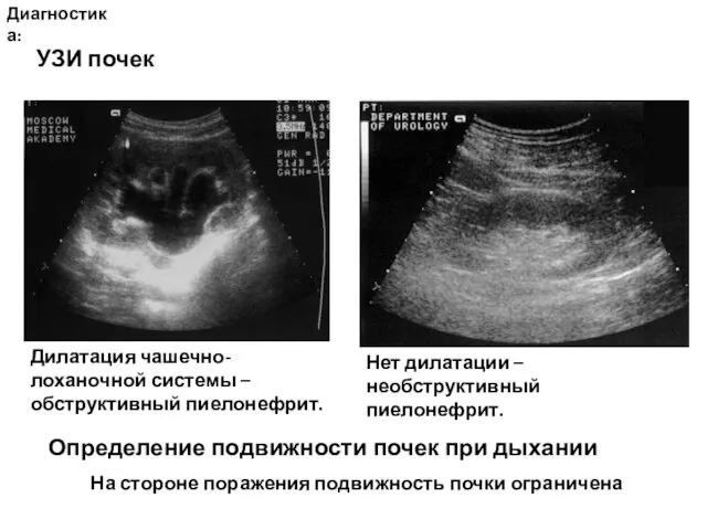 Диагностика: УЗИ почек Дилатация чашечно-лоханочной системы – обструктивный пиелонефрит. Нет дилатации