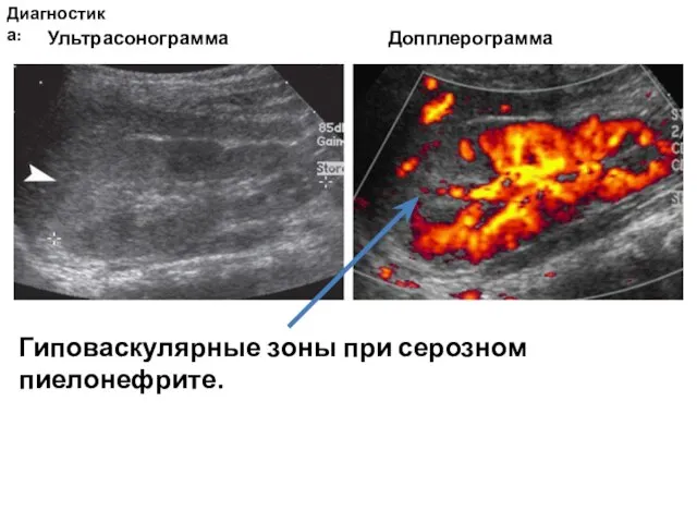 Диагностика: Гиповаскулярные зоны при серозном пиелонефрите. Ультрасонограмма Допплерограмма