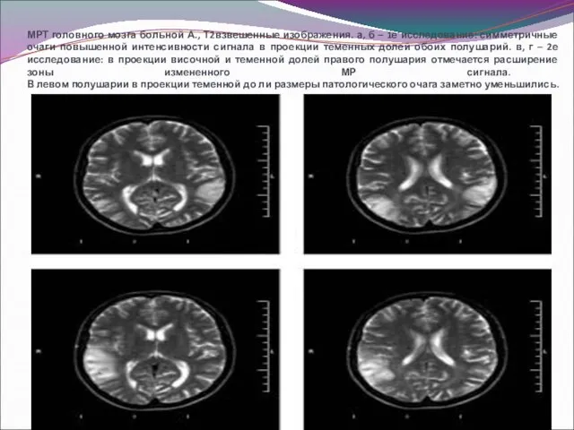 МРТ головного мозга больной А., Т2взвешенные изображения. а, б – 1е