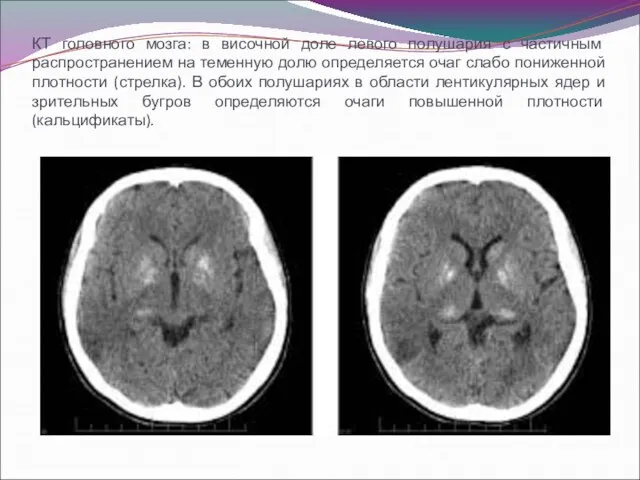 КТ головного мозга: в височной доле левого полушария с частичным распространением