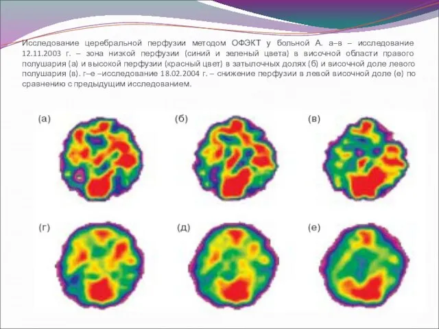 Исследование церебральной перфузии методом ОФЭКТ у больной А. а–в – исследование