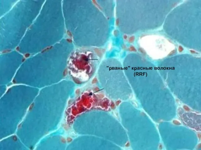 "рваные" красные волокна (RRF)