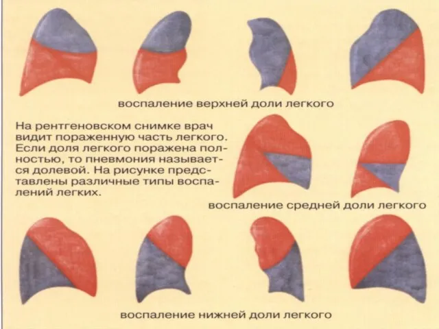 Встречается редко, чаще у детей школьного возраста. Клиника: Нарастающий синдром интоксикации