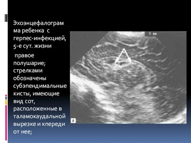 Эхоэнцефалограмма ребенка с герпес-инфекцией, 5-е сут. жизни правое полушарие; стрелками обозначены