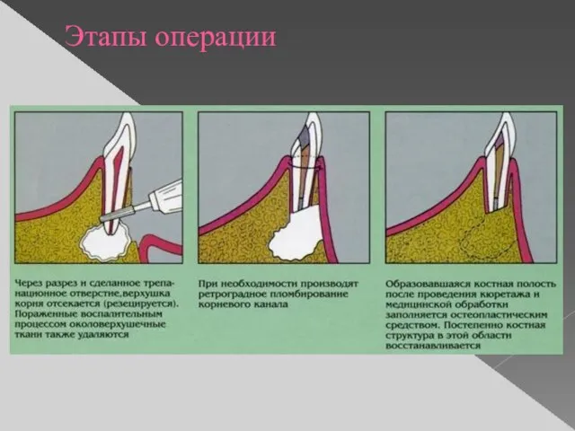 Этапы операции