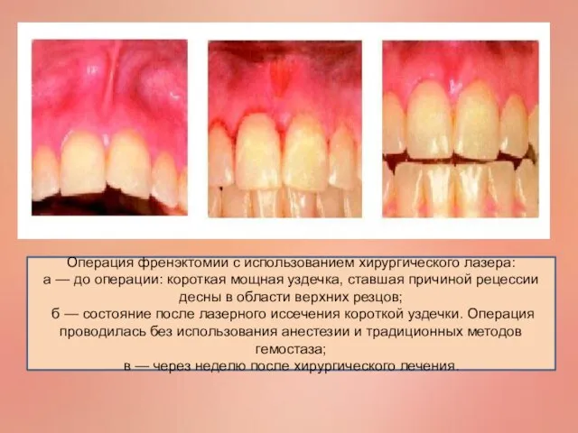 Операция френэктомии с использованием хирургического лазера: а — до операции: короткая