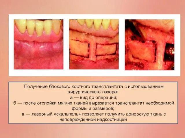 Получение блокового костного трансплантата с использованием хирургического лазера: а — вид