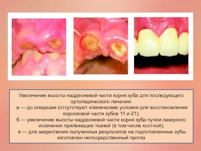 Увеличение высоты наддесневой части корня зуба для последующего ортопедического лечения: а