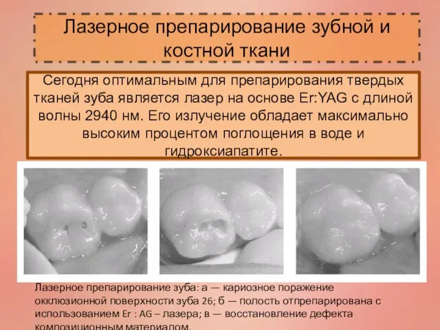 Лазерное препарирование зубной и костной ткани Сегодня оптимальным для препарирования твердых