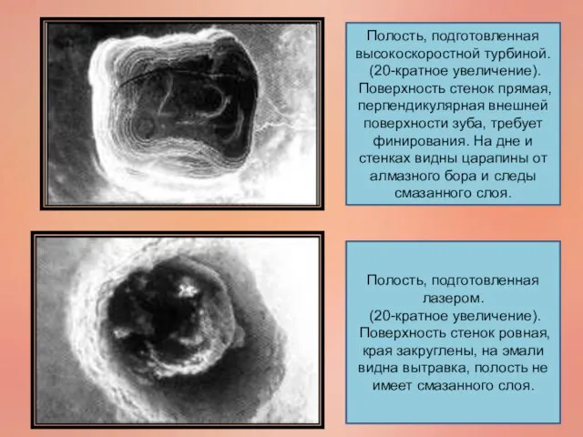 Полость, подготовленная высокоскоростной турбиной. (20-кратное увеличение). Поверхность стенок прямая, перпендикулярная внешней