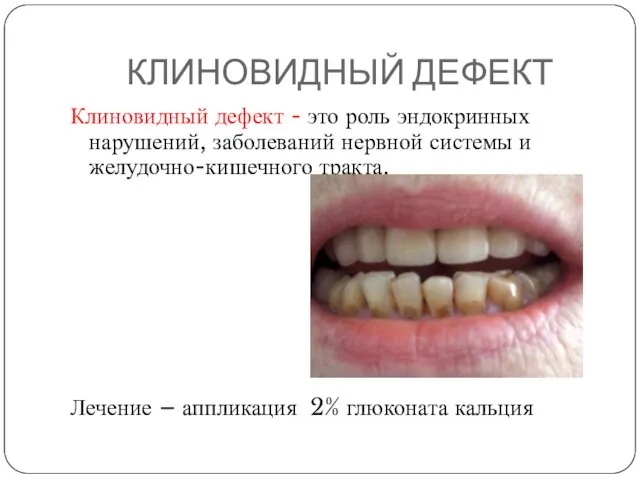 КЛИНОВИДНЫЙ ДЕФЕКТ Клиновидный дефект - это роль эндокринных нарушений, заболеваний нервной