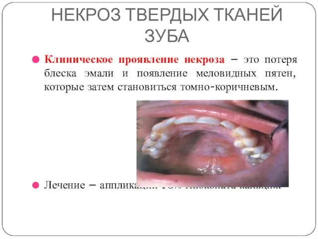 НЕКРОЗ ТВЕРДЫХ ТКАНЕЙ ЗУБА Клиническое проявление некроза – это потеря блеска