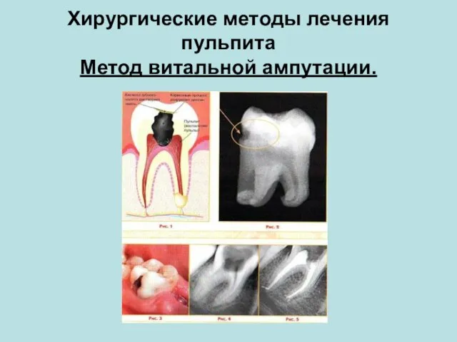 Хирургические методы лечения пульпита Метод витальной ампутации.