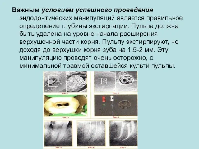 Важным условием успешного проведения эндодонтических манипуляций является правильное определение глубины экстирпации.