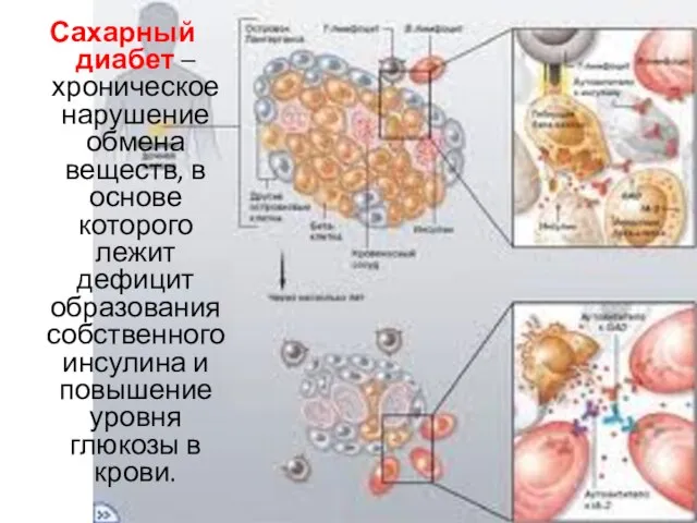 Сахарный диабет – хроническое нарушение обмена веществ, в основе которого лежит