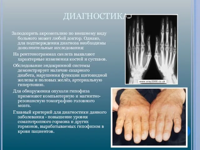 ДИАГНОСТИКА Заподозрить акромегалию по внешнему виду больного может любой доктор. Однако,