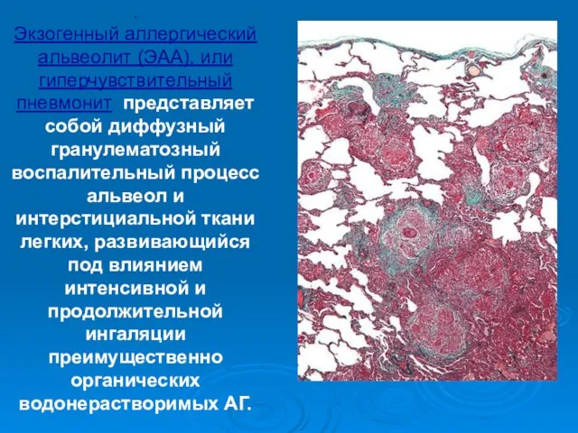 . Экзогенный аллергический альвеолит (ЭАА), или гиперчувствительный пневмонит представляет собой диффузный