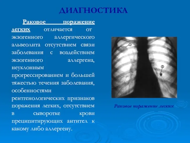 Раковое поражение легких отличается от экзогенного аллергического альвеолита отсутствием связи заболевания