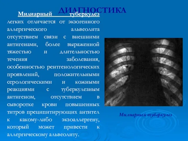 ДИАГНОСТИКА Милиарный туберкулез легких отличается от экзогенного аллергического альвеолита отсутствием связи