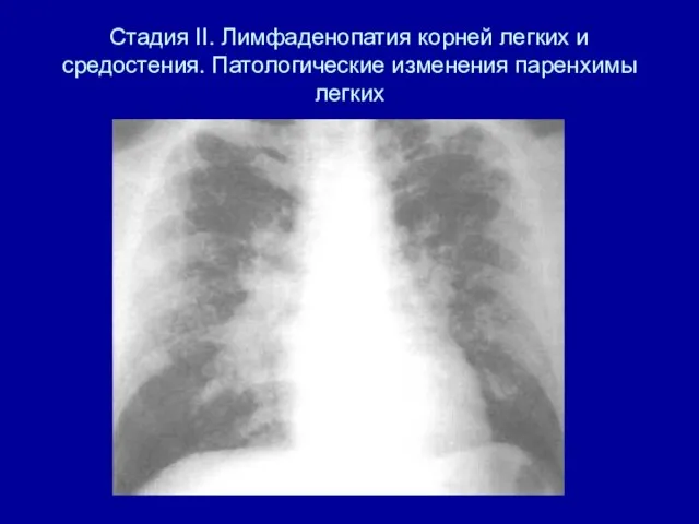 Стадия II. Лимфаденопатия корней легких и средостения. Патологические изменения паренхимы легких