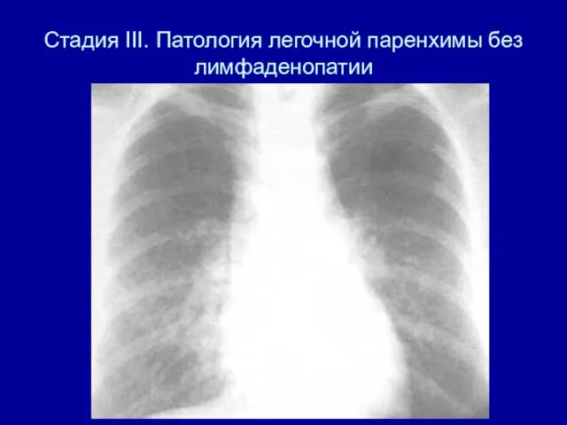 Стадия III. Патология легочной паренхимы без лимфаденопатии