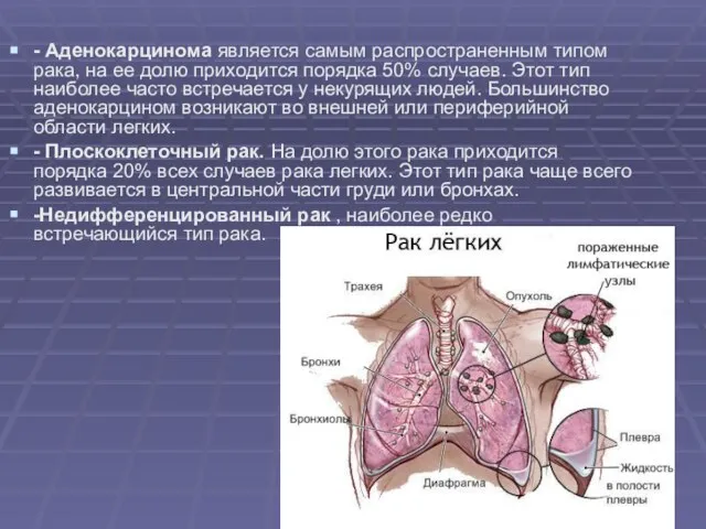 - Аденокарцинома является самым распространенным типом рака, на ее долю приходится