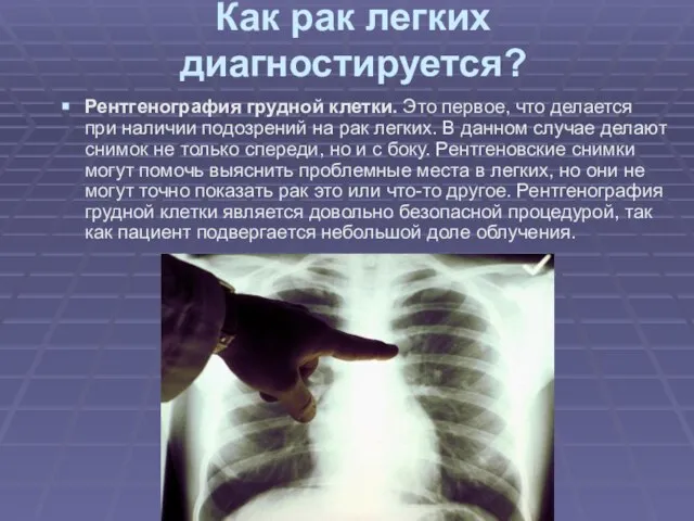 Как рак легких диагностируется? Рентгенография грудной клетки. Это первое, что делается