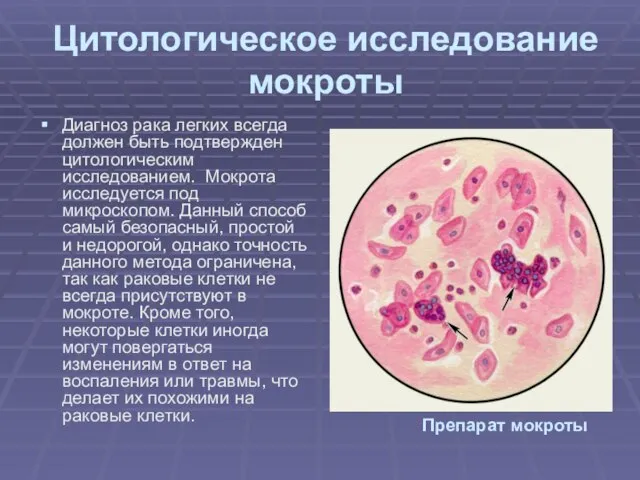 Цитологическое исследование мокроты Диагноз рака легких всегда должен быть подтвержден цитологическим