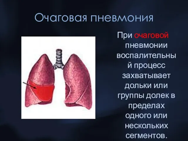 Очаговая пневмония При очаговой пневмонии воспалительный процесс захватывает дольки или группы