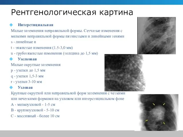 Рентгенологическая картина Интерстициальная Малые затемнения неправильной формы. Сетчатые изменения с мелкими