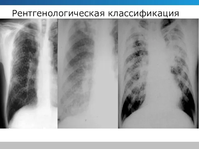 Рентгенологическая классификация I стадия-интерстициальные изменения (ячеистый и линейный легочный рисунок), или